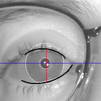 Eyelid Measurements Using Digital Video Processing